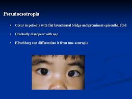Findings may include a smooth philtrum, thin upper lip, upturned nose, flat nasal bridge and midface, epicanthal folds, small palpebral fissures, and small head circumference. Strabismus Amblyopia Leukocoria Dr Hessah Alodan Pediatric Opthalmology