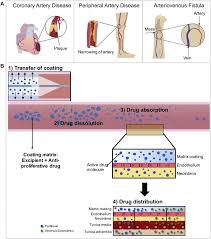 Maris deep (ses);014 & 018. Materials Technology In Drug Eluting Balloons Current And Future Perspectives Sciencedirect