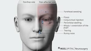 Image result for Acute Localized Headache