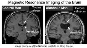 Deficit Of Thiamine In Wernicke Korsakoff Syndrome