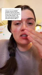 How to Soothe Burning and Dry Skin