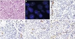 Immunohistochemical detection of mtap and bap1 protein loss for mesothelioma diagnosis: Immunohistochemical Detection Of Mtap And Bap1 Protein Loss For Mesothelioma Diagnosis Comparison With 9p21 Fish And Bap1 Immunohistochemistry Semantic Scholar