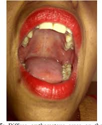 Image result for Hand foot and mouth disease HFMD roof of mouth