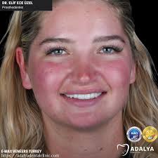 Emax-Kronen in der Türkei