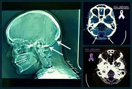 Ct Scan Of Successful Chiari Decompression 3in By 2in Skull Removal In Tact Tonsils C1 Laminectomy Duraplasty Wit Chiari Spinal Fluid Chiari Malformation