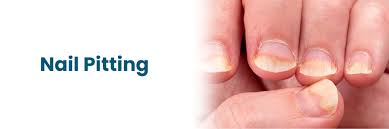 Image result for Nail Pitting