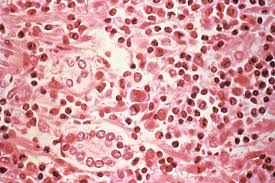 Hps is a rare but often serious illness of the lungs. Hantavirus Virus Britannica