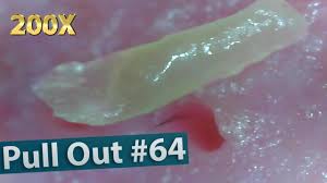 Face blackheads removal close up. Pulling Out Blackheads With Tweezers