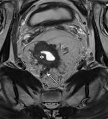 El libertino invisible pdf mirror link #1. Multimodality Imaging Of Abdominopelvic Tumors With Venous Invasion Radiographics