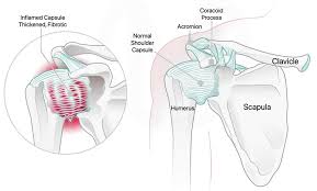 Image result for Shoulder History