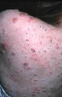Check spelling or type a new query. Transmission Molluscum Contagiosum Pox Viruses Cdc