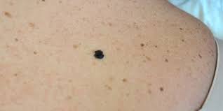 In people with darker skin tones, melanoma tends to occur on the palms or soles, or under the fingernails or toenails. Melanoma Skin Cancer Treatment Norris Dermatology Portland Or