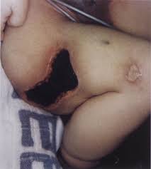 Presentation varies from asymptomatic to venous thromboembolism to neonatal purpura fulminans. Purpura Fulminans Skin Lesions In A Newborn With Complete Protein C Deficiency The Journal Of Pediatrics