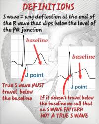 Image result for Early Repolarization