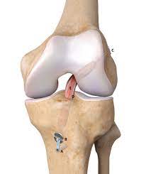 Acl awards more than one billion dollars in grants, primarily to state and local governments, nonprofit organizations, institutions of higher education and small businesses. Diagram Of The Anterior Cruciate Ligament Acl Reconstruction Aclr Download Scientific Diagram