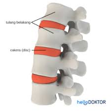 Flap disc umumnya digunakan untuk pemolesan finishing besi. Gelinciran Cakera Slipped Disc Yang Menyebabkan Sakit Belakang