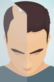 Check out 17 of the best fixes and remedies for hair loss. Male Hair Transplant Uk Cost And Things To Consider British Gq British Gq