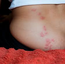 these horrifying pictures show exactly what bed bug bites look like bed bug bites bed bugs bug bites