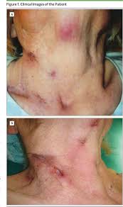 Tuberkulöse gumma) tuberkulose der subkutis; Pdf Recurrent Abscesses Of The Neck Scrofuloderma Semantic Scholar