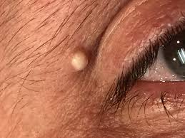 Image result for milium cyst on eyelid