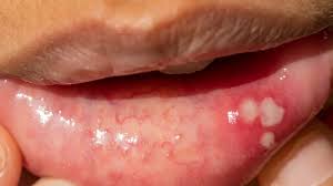 Image result for Canker sores symptoms roof of the mouth