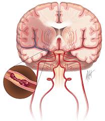 When an area of the brain is damaged from a stroke, the loss of normal function of part of the body may occur. Ischemic Stroke Saudi Stroke Society