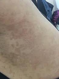 Kahverengi Lekeler Kizlarsoruyor