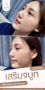 เสริมจมูก 𝐒𝐢𝐠𝐧𝐚𝐭𝐮𝐫𝐞 𝐍𝐨𝐬𝐞 หลังทำครบ 2 สัปดาห์ค่า สโลปสวย  ปลายพุ่งมากค่ะ 💕 จมูกทรงสวยได้รูป ใบหน้าหวานขึ้น 💕 สโลปปลายพุ่งสวยเป๊ะ 💕  สวยและปลอดภัย ยิ่งนานยิ่งสวยค่ะ . #เสริมจมูกเทคนิค 𝐒𝐢𝐠𝐧𝐚𝐭𝐮𝐫𝐞  𝐍𝐨𝐬𝐞 ￼รองปลายจมูกด้วยเนื้อเยื่อ ...