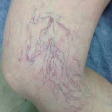 What Are Spider Veins The Leg Vein Doctor Brisbane Varicose And Spider Vein Phlebology Clinic