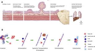 Cancers that affect either of these organs may be called colorectal cancer. A Tissue Engineering Approach To Metastatic Colon Cancer Sciencedirect