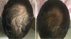 Does biotin work for hair growth? Which Is The Best Biotin Supplement For Hair Available In India Quora