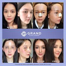 Pin En Grand Plastic Surgery