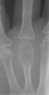 If you notice any of. Bone Tumor Wikipedia