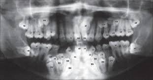 X Ray Showing Hyperdontia Hyperdontia Dental Humor Dental Facts