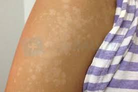 Deixe uma resposta cancelar resposta. 7 Tipos De Micose De Pele E Como Tratar Tua Saude