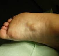 Plantaire fibromatose (morbus Ledderhose)