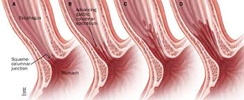 Image result for esophagus