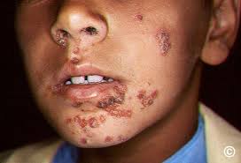 Image result for Impetigo