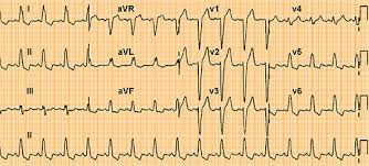 Myocarditis is an inflammatory disease of the myocardium with a wide range of clinical presentations, from subtle to devastating. Pruebas Diagnosticas