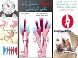 جراحة السمنة و السكر بالمنظار تحويل مسار مصغر للمعده تكميم المعدة أ د علاء العشرى للمواعيد 0020127200026 knee osteoarthritis osteoarthritis cards