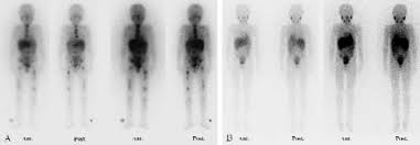 Staging systems • international neuroblastoma staging system (inss). A Five Year Old Child With Neuroblastoma Stage 4 Treated With 250 Mci Download Scientific Diagram