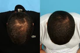 If patients are considering prp therapy, it would likely be helpful to consult with a hair restoration expert and discuss the treatment. Male Prp 005 Vampire Prp Or Platelet Rich Plasma Is A Hair Flickr