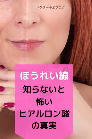 ヒアルロン酸注射でリフトアップする方法 有名人の整形手術 ヒアルロン酸 美容