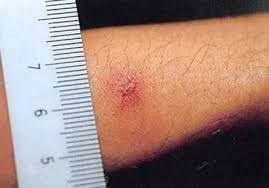 Escharotomy simply means opening the eschar. File Scrub Typhus Eschar Jpg Wikipedia