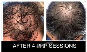 Oral finasteride is a prescription medication for men who have male pattern hair loss, or androgenetic alopecia. Prp Winnipeg Non Surgical Hair Loss Solutions Minuk Laser Centre Winnipeg Manitoba Canada