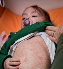 Image result for measles