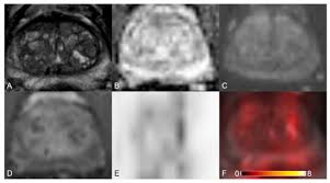 Prostate cancer is a common type of cancer in men, according to the mayo clinic. Cancers Free Full Text Correlation Between Intraprostatic Psma Uptake And Mri Pi Rads Of 68ga Ga Psma 11 Pet Mri In Patients With Prostate Cancer Comparison Of Pi Rads Version 2 0 And Pi Rads Version 2 1 Html