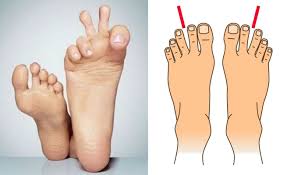 11 does the number of toes of the image have special meaning? 9 Kepribadian Kamu Jika Dilihat Dari Bentuk Jari Kaki Cek Di Sini