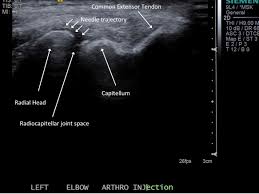 Image result for Elbow Joint Injection