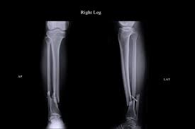 Major Trial Casts Doubt On Leading Device To Heal Bone Fractures